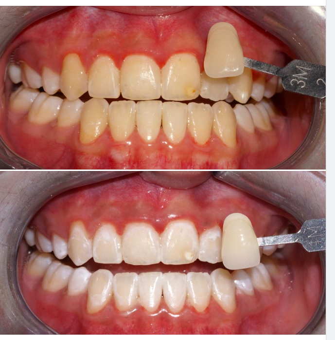 Một ca tẩy trắng răng bằng hệ thống Zoom tại chi nhánh 288/1 Huỳnh Văn Bánh, do bác sĩ Huyền thực hiện!