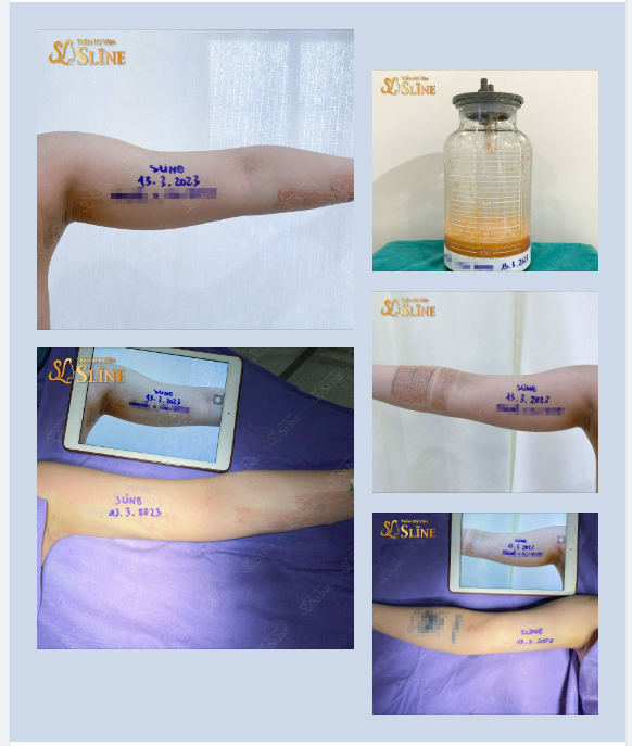 HÚT MỠ CÁNH TAY VASER LIPO