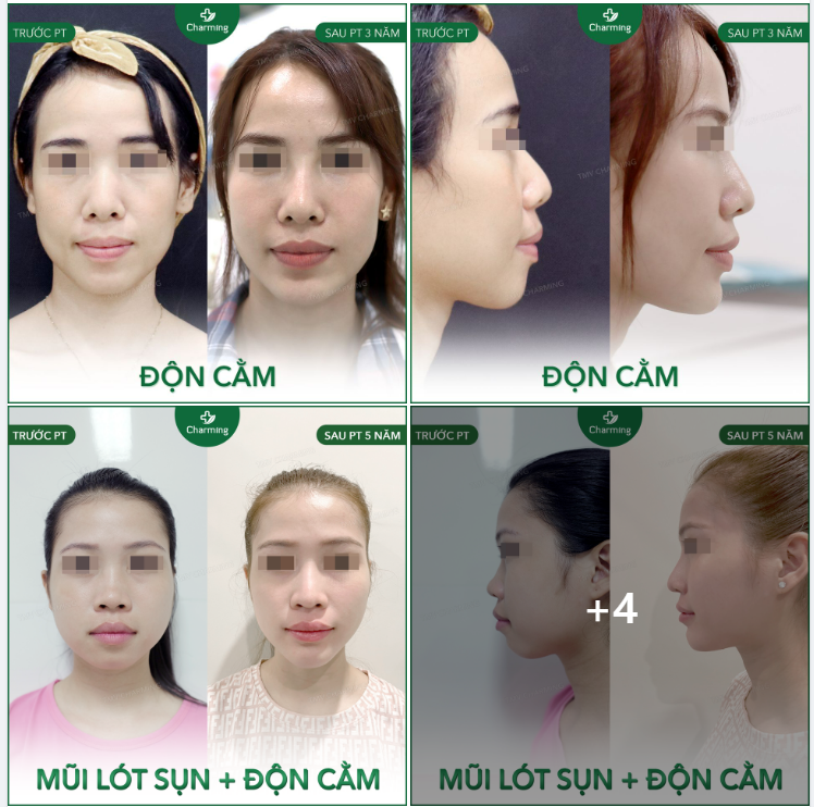 Một vài hình ảnh ĐỘN CẰM tẠI Thẩm mỹ viện Charming. Charming tổng hợp lại cho Khách hàng dễ tham khảo hơn nhé ạ!