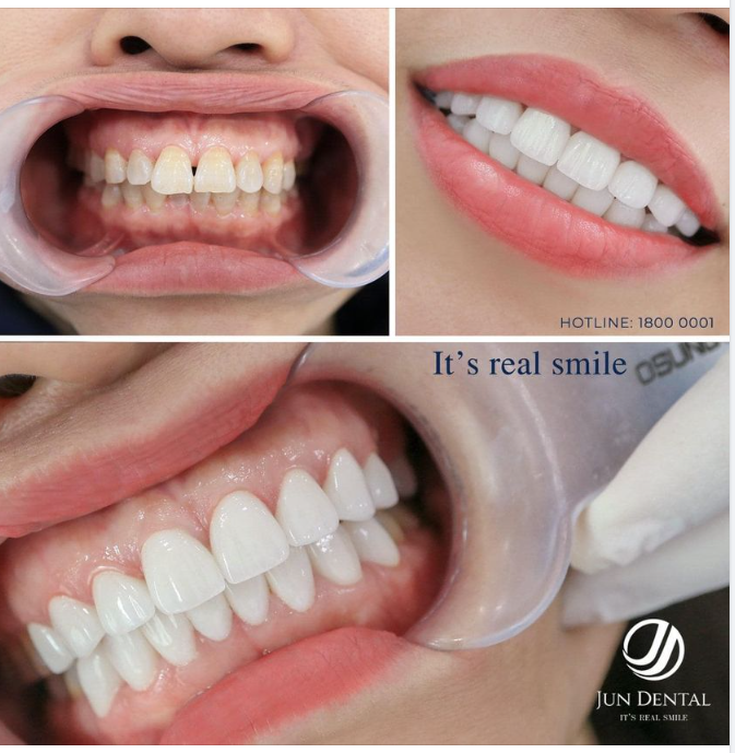 TÌM LẠI NỤ CƯỜI TỰ TIN TRẮNG KHOẺ CHO CHỊ KHÁCH 47 TUỔI