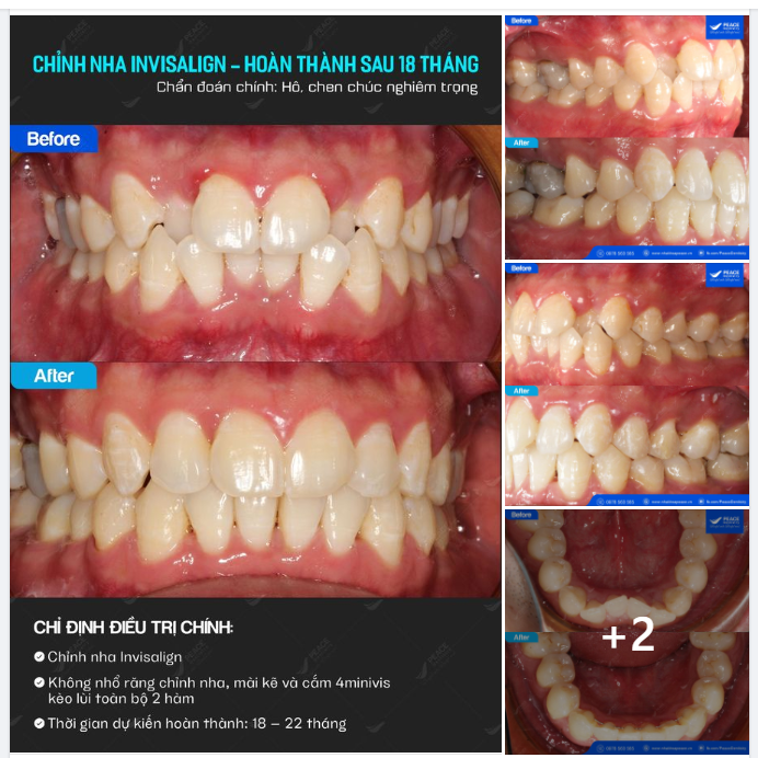Tình trạng hô khắc phục triệt để, khớp cắn chuẩn, cung răng đều - đẹp;
