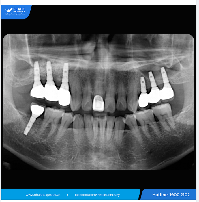 RĂNG IMPLANT ĐÓNG VAI TRÒ NHƯ RĂNG THẬT