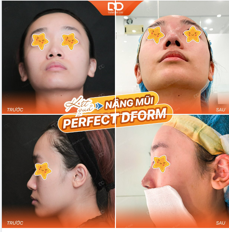 NÂNG MŨI PERFECT DFORM - KỸ THUẬT TẠO HÌNH LỖ MŨI HẠT CHANH THANH THOÁT