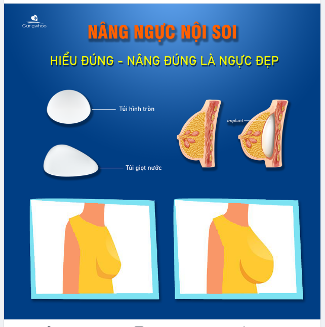 NÂNG NGỰC NỘI SOI - HIỂU ĐÚNG, NÂNG ĐÚNG LÀ NGỰC ĐẸP