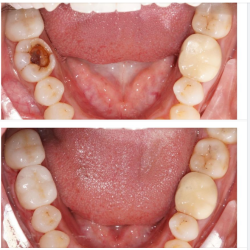 Khách hàng đến vì tình trạng răng hàm sâu lớn, nứt dọc thân răng làm nhét thức ăn và gây ê buốt, được Bác sĩ tư vấn phục hình sứ Cercon răng 46.