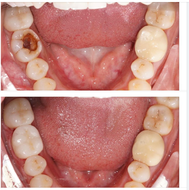 Khách hàng đến vì tình trạng răng hàm sâu lớn, nứt dọc thân răng làm nhét thức ăn và gây ê buốt, được Bác sĩ tư vấn phục hình sứ Cercon răng 46.