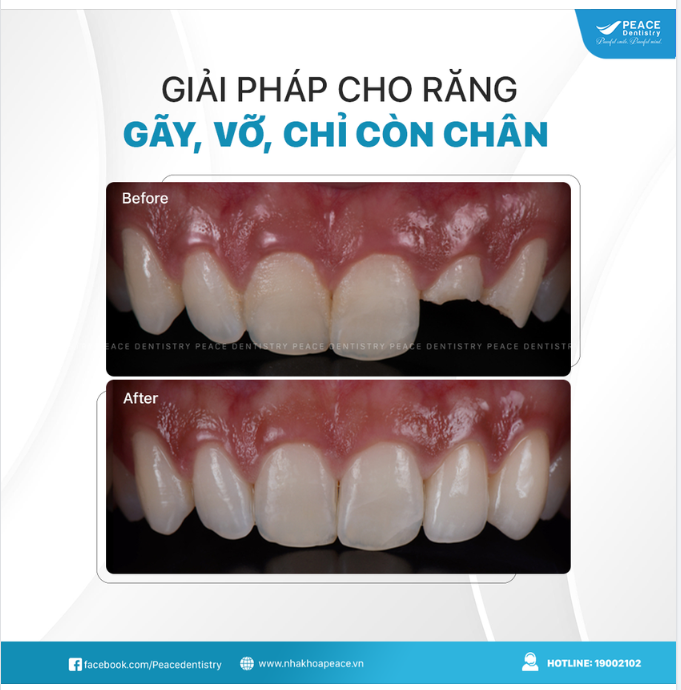 RĂNG GÃY CHỈ CÒN CHÂN