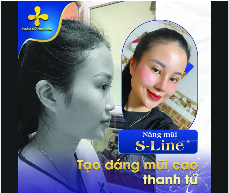 Nâng mũi S-Line sẽ thay đổi đáng kể dáng mũi ban đầu, mang đến cho bạn dáng mũi mới cao hơn, đẹp hơn.