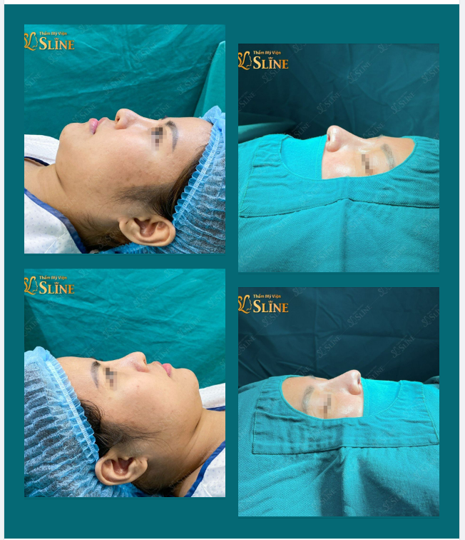 NÂNG MŨI MỘT CHÚT - MÊ HƠN BỘI PHẦN