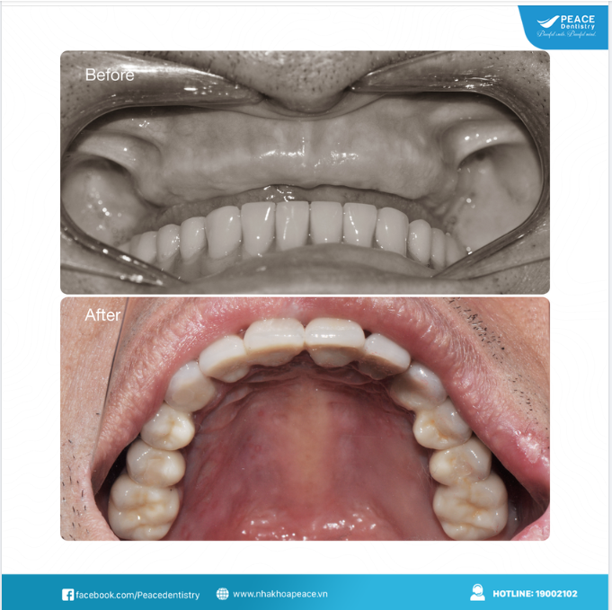 Ca lâm sàng trồng răng implant toàn hàm mang đến nụ cười trọn vẹn