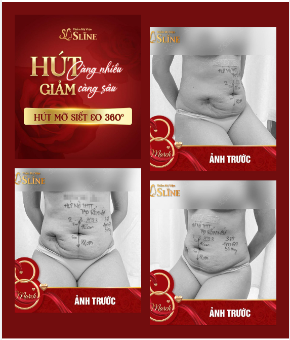 LẠI LÀ SLINE VÀ NHỮNG CASE BỤNG CỰC “HÓC BÚA”