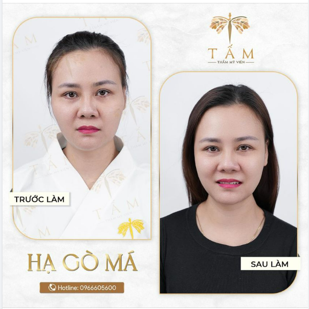 Ưu điểm của phương pháp tiêm hạ gò má: