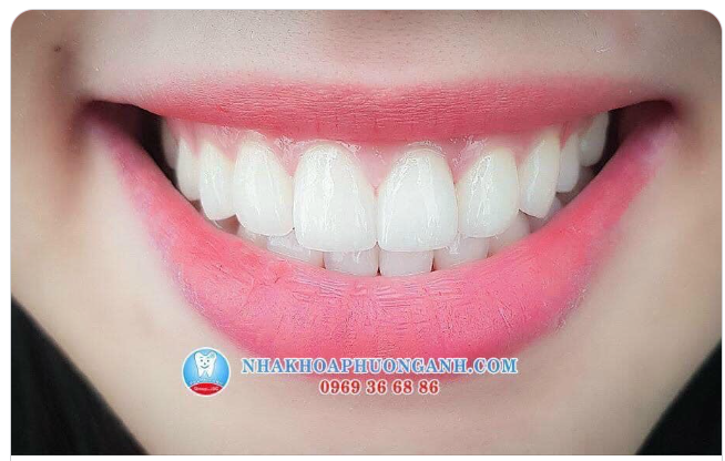 MẶT DÁN SỨ VENEER LÀ GÌ?