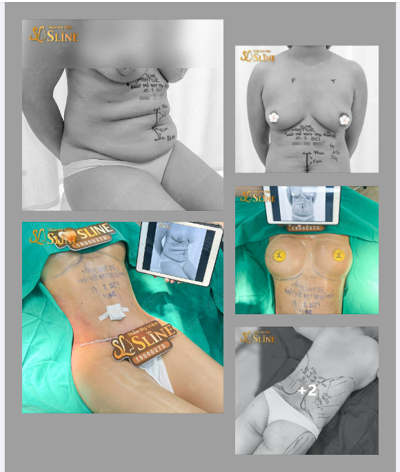 “ĐẠI TU” BODY 3 VÒNG BỞI EKIP SLINE