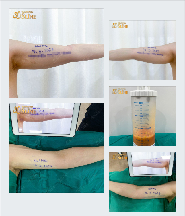 30 PHÚT ​​​​​​​ CÁNH TAY THANH MẢNH
