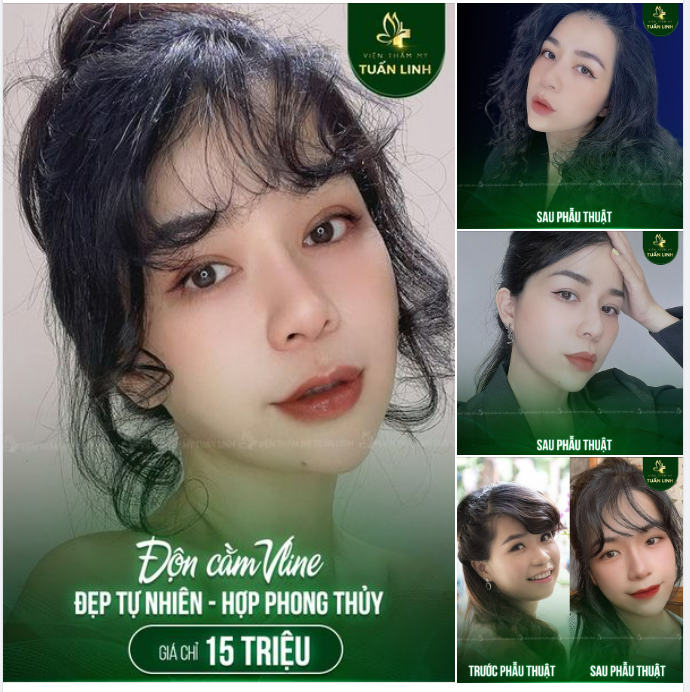 Chọn ngay độn cằm Vline để cải thiện hô móm, cằm ngắn lẹm kém sang!!