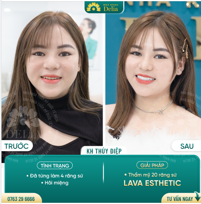 Thẩm mỹ 20 răng sứ Lava Esthetic - Bí quyết giúp chị Thúy Điệp có nụ cười rạng ngời!