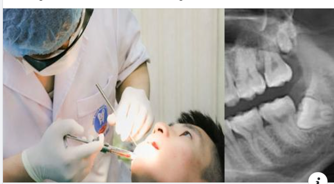 Hướng dẫn chăm sóc sau khi nhổ răng khôn