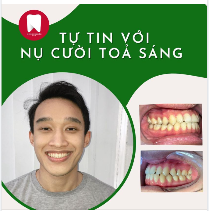 TẠM BIỆT HÀM RĂNG KHẤP KHỂNH LỆCH LẠC NHỜ NIỀNG RĂNG