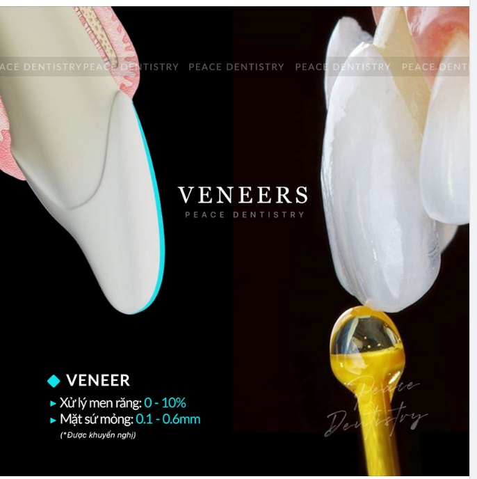 MẶT SỨ VENEER MỎNG VÀ SÁT KHÍT THẾ NÀO?
