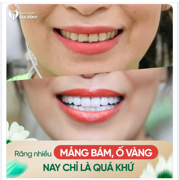 RĂNG NHIỀU MẢNG BÁM Ố VÀNG, SỨT MẺ NAY CHỈ LÀ QUÁ KHỨ