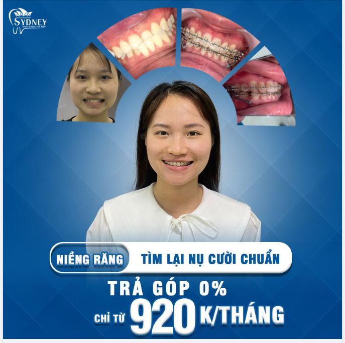 Người bị móm có nên niềng răng niềng răng mắc cài trong suốt?