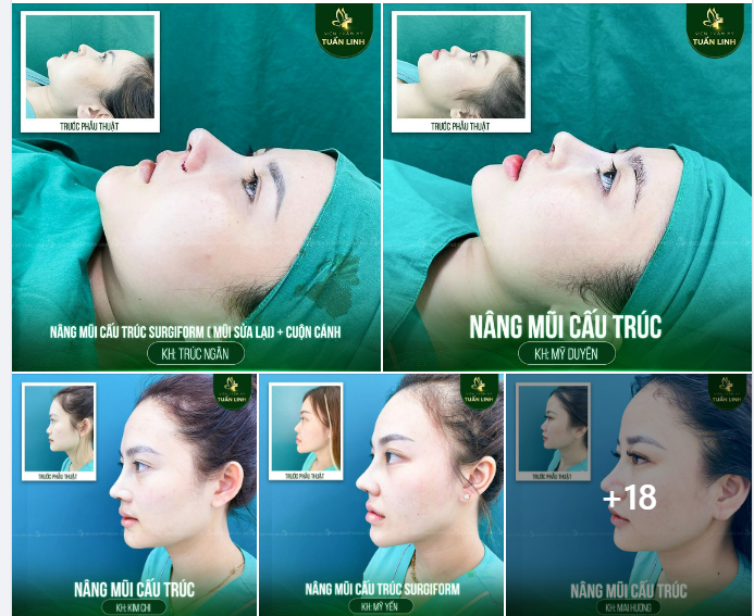 30 CA NÂNG MŨI TRONG NGÀY TẠI TUẤN LINH!!