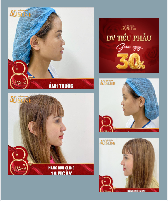MŨI ĐẸP  SAU 16 NGÀY.