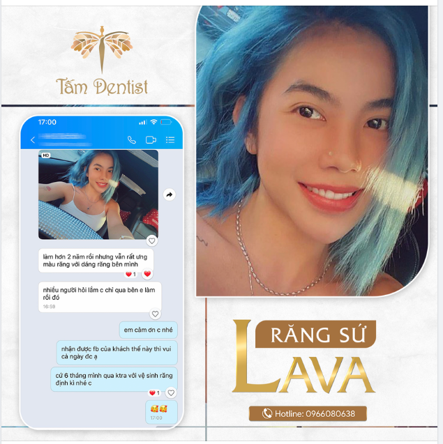Khách hàng sở hữu nụ cười vô cùng xinh đẹp, tự tin, cuốn hút sau khi bọc 20 răng sứ Lava cao cấp tại Tấm Dentist.