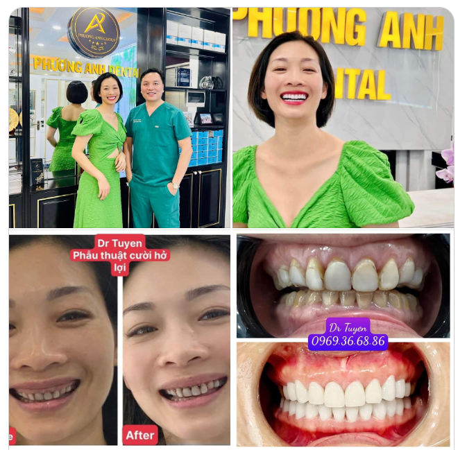 ĐIỀU TRỊ CƯỜI HỞ NƯỚU :