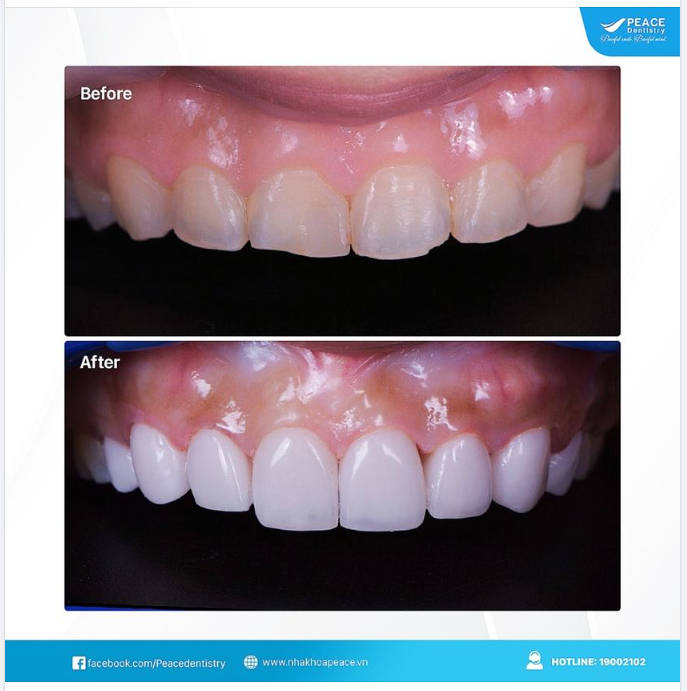 CÁC LOẠI MẶT DÁN SỨ VENEER PHỔ BIẾN