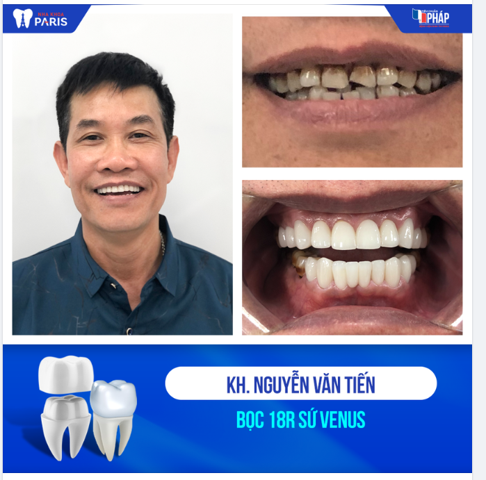 Với 18 răng sứ Venus, anh Tiến vừa cải thiện được thẩm mỹ lại vừa đảm bảo chức năng ăn nhai như răng thật.