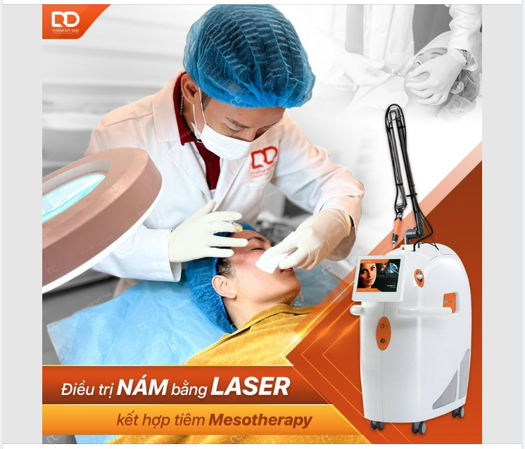 ĐIỀU TRỊ NÁM BẰNG LASER KẾT HỢP TIÊM MESOTHERAPY!