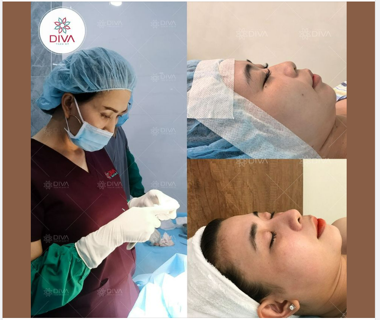 CẢI THIỆN SỐNG MŨI THẤP, CÁNH MŨI TO BÈ SAU THẨM MỸ NÂNG MŨI VÀ CẮT CÁNH MŨI