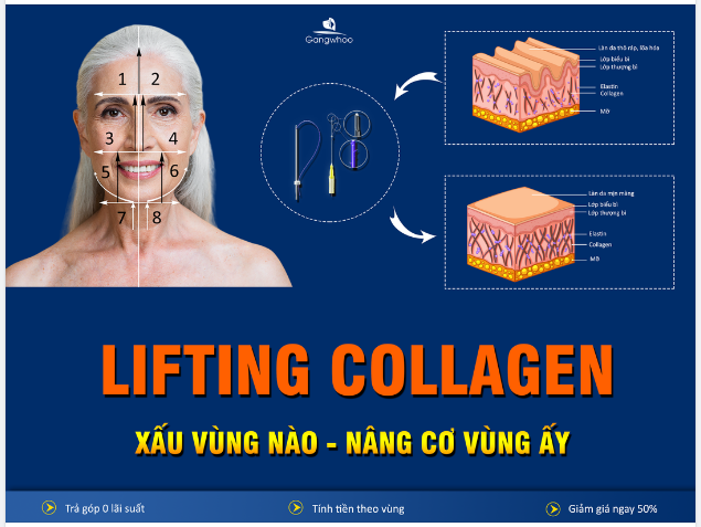 CĂNG DA LIFTING COLLAGEN - XẤU VÙNG NÀO, NÂNG CƠ VÙNG ẤY