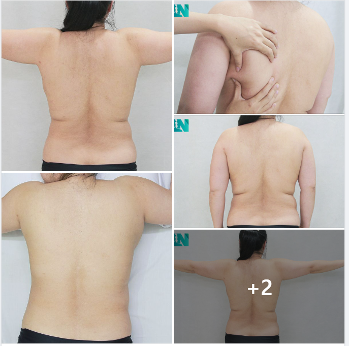  HÚT MỠ TẠO DÁNG THẨM MỸ VÙNG TAY LƯNG NÁCH CHO CHỊ KH U50