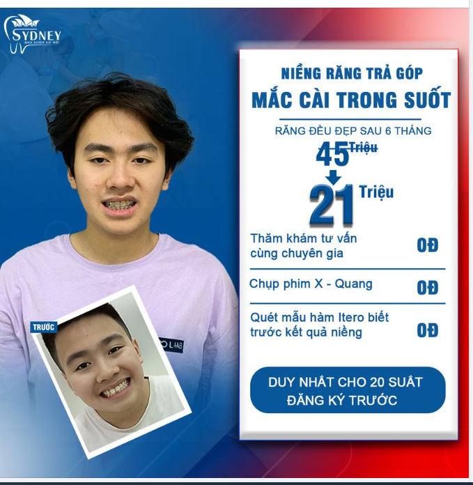 Niềng răng mắc cài pha lê – niềng răng thẩm mỹ cho hiệu quả vượt trội