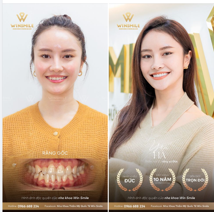 TRẺ TRUNG HƠN, THẦN THÁI HƠN VỚI NỤ CƯỜI MỚI