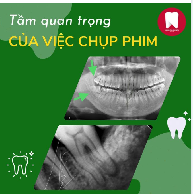 TẦM QUAN TRỌNG CỦA VIỆC CHỤP PHIM RĂNG