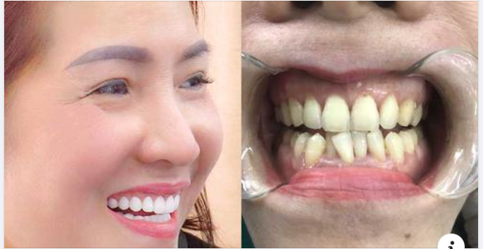 Cách Chăm Sóc Để Răng Sứ Tồn Tại Lâu Dài Hơn