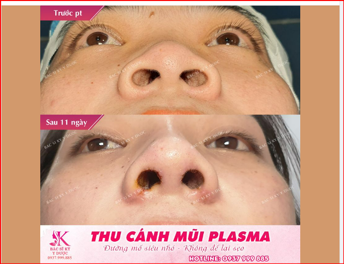 THU CÁNH MŨI ĐƯỜNG MỔ SIÊU NHỎ - KHÔNG ĐỂ LẠI SẸO