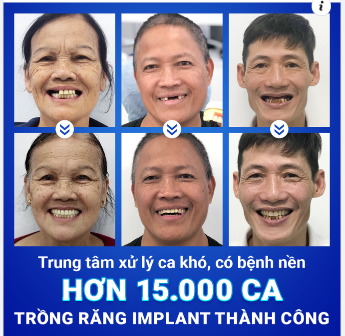 HƠN 15,000 KH ĐÃ ĐƯỢC KHÔI PHỤC RĂNG THÀNH CÔNG