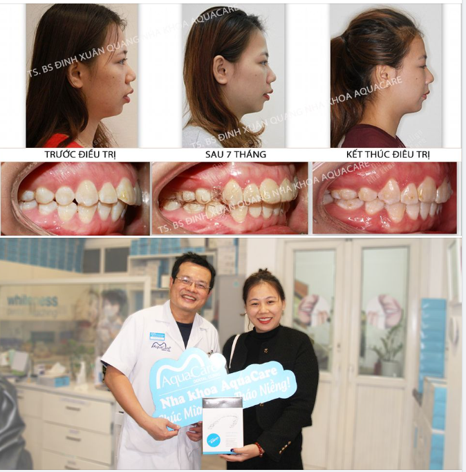 Chúc mừng chị Thùy Linh đã kết thúc quá trình chỉnh nha và chuyển sang giai đoạn đeo hàm duy trì Vivera!