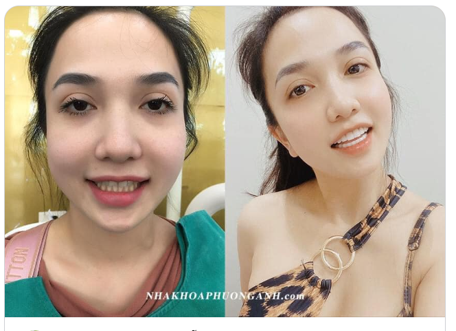 LÀM RĂNG ĐẸP - CƯỜI XINH NHƯ MẪU!