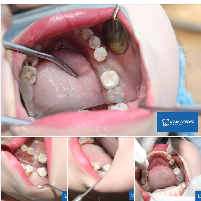 Phục hình implant răng hàm cho chị Hồng Thuý.