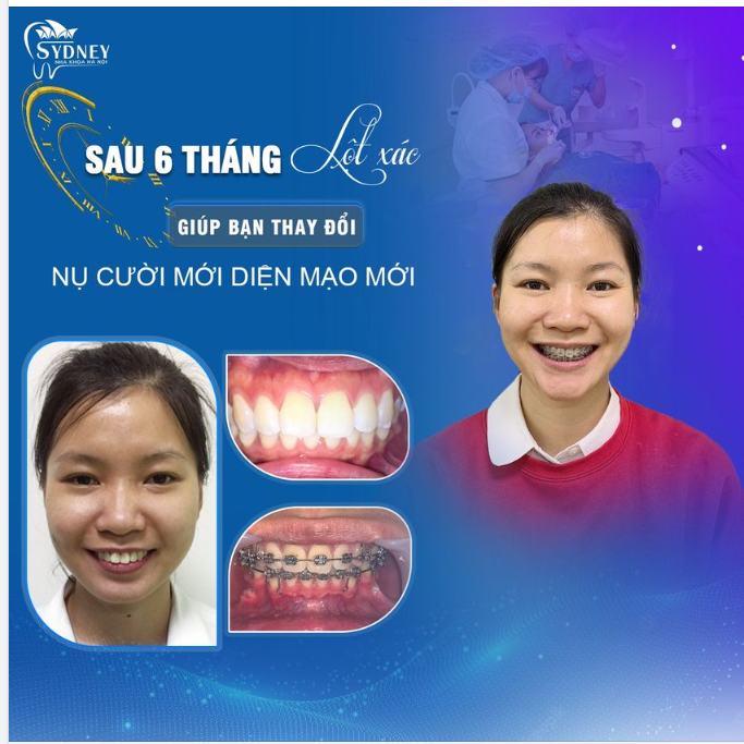 Khắc phục răng hô chìa bằng mắc cài kim loại