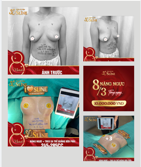 “GIẢI CỨU” thành công case ngực lệch ,sa trễ không đồng đều.