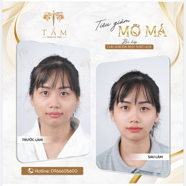 TẠM BIỆT MẶT BÁNH BAO CHỈ SAU 1 LẦN TIÊM