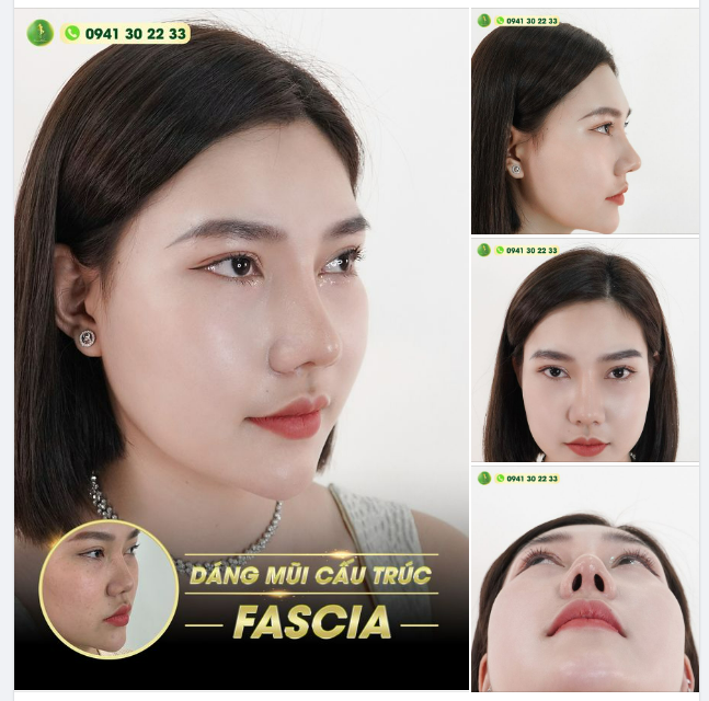 HOT TIKTOKER THẢO NHI KHOE DÁNG MŨI CẤU TRÚC FASCIA SAU 1 THÁNG THỰC HIỆN