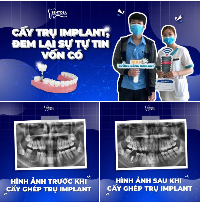 GIÁ TRỊ KHI LỰA CHỌN DỊCH VỤ IMPLANT LÀ GÌ?